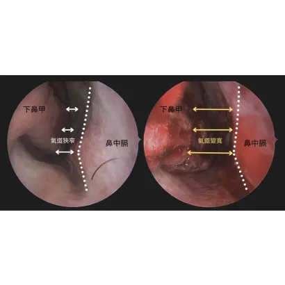 鼻過敏相關手術