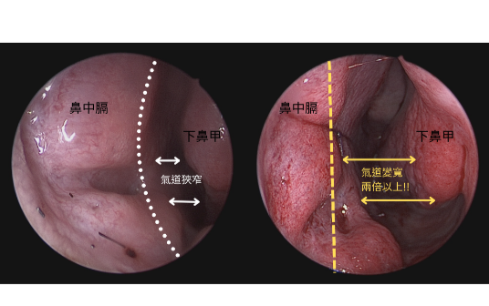 雙北鼻部微創手術案例術前術後氣道內視鏡對比圖一